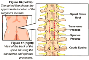 Figure 6 & 7: Back Incision