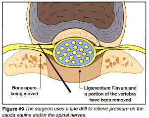 Figure 9: Back Surgery