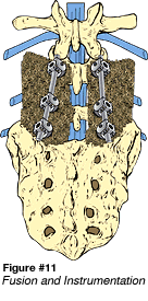 Figure 11: Fusion & Instrumentation
