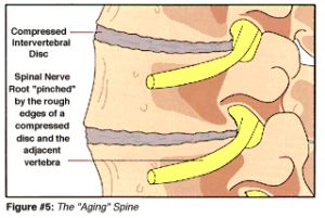 Figure 5: The Aging Spine