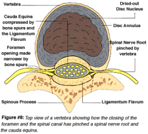Figure 8: Pinched Spinal Nerve